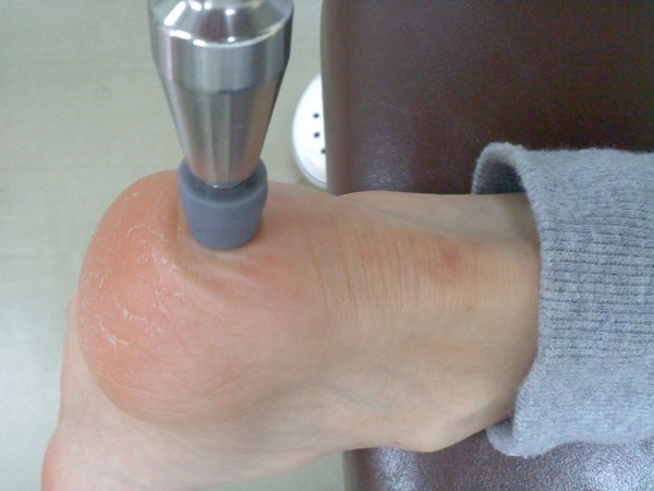足底腱膜炎の施術の写真１.JPG