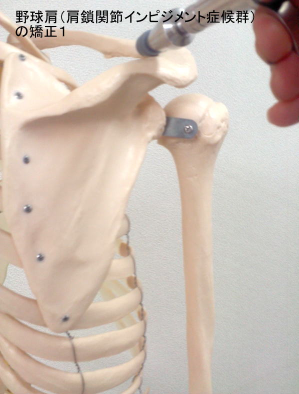 野球肩（肩鎖関節インピジメント症候群）の矯正1.jpg