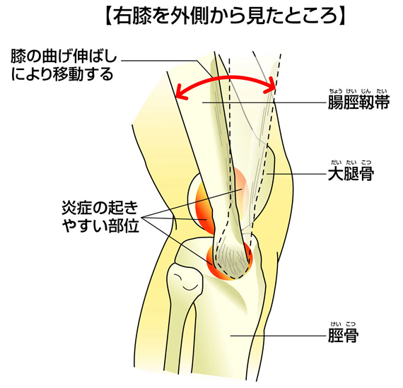 ファミリーカイロプラクティック腸脛靭帯炎-.jpg