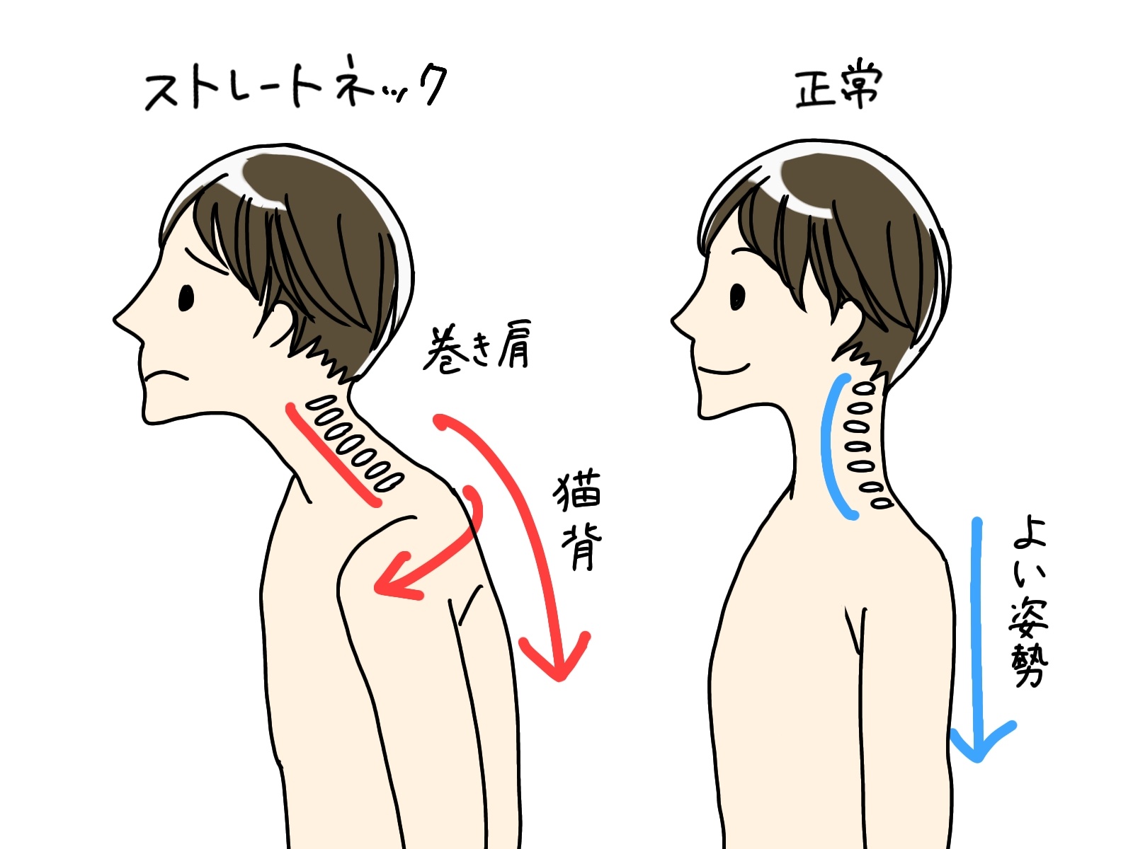 下を向いてスマホを操作することで首や肩に負担がかかるストレートネック・スマホ首の仕組みのイラスト