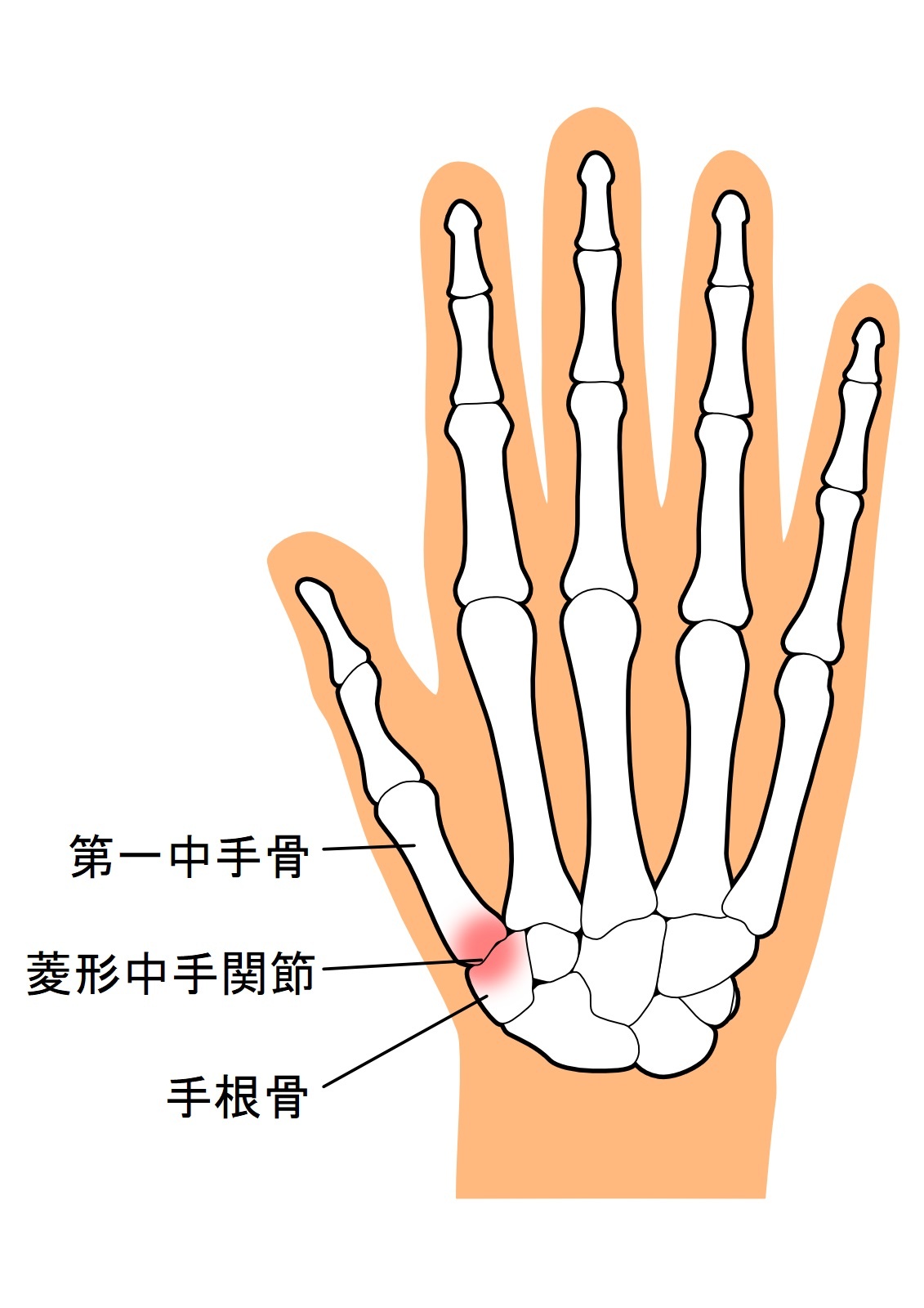 親指の腱鞘炎の矯正ポイント