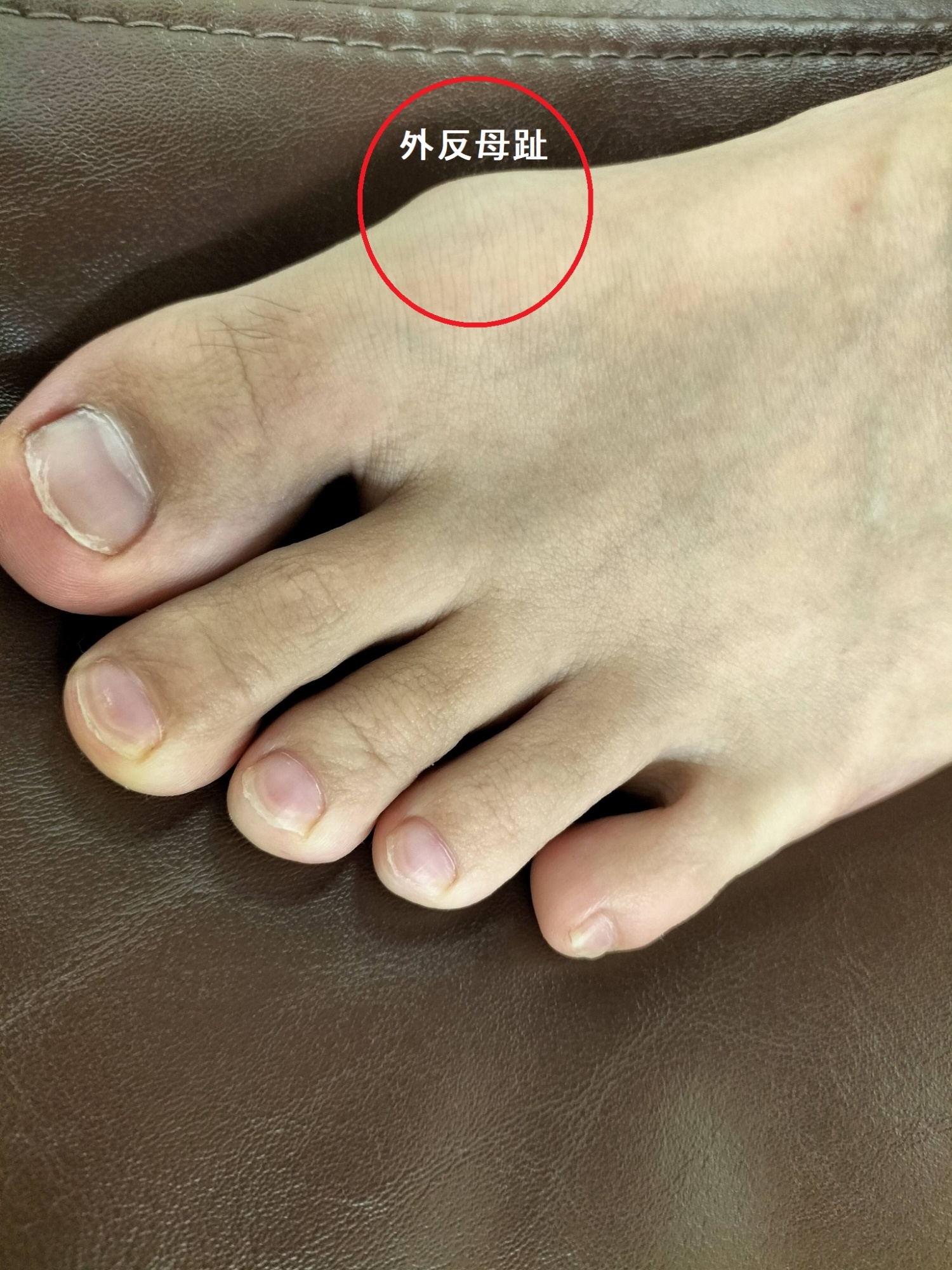 外反母趾