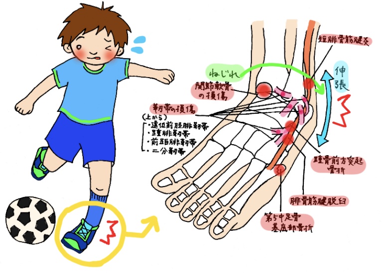 足首の捻挫のメカニズムイラスト(内反捻挫で足首の外側の靭帯が引っ張られ、関節がズレる様子)