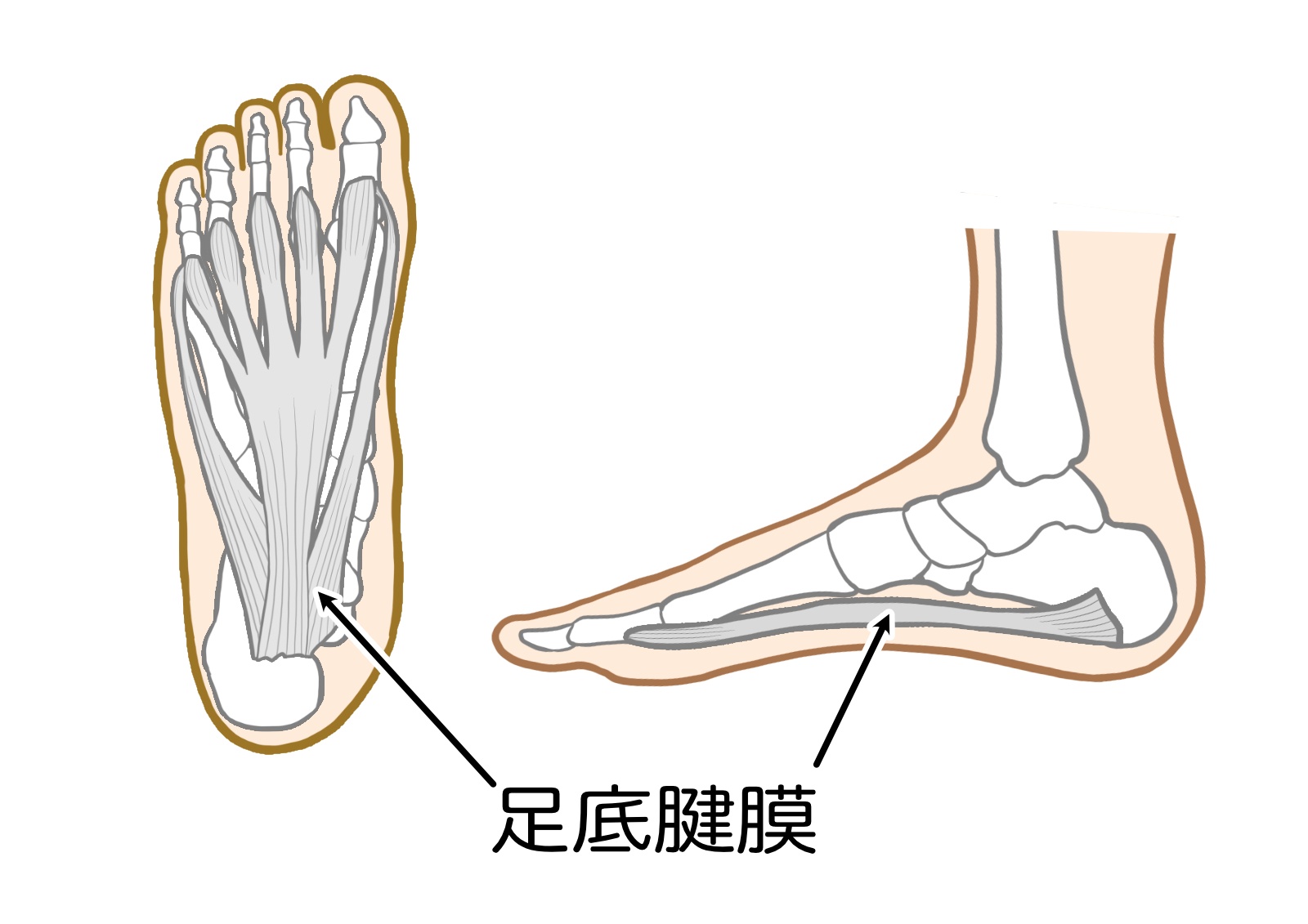 足の裏の筋肉の膜(足底腱膜)が引っ張られて炎症を起こし痛むイメージイラスト