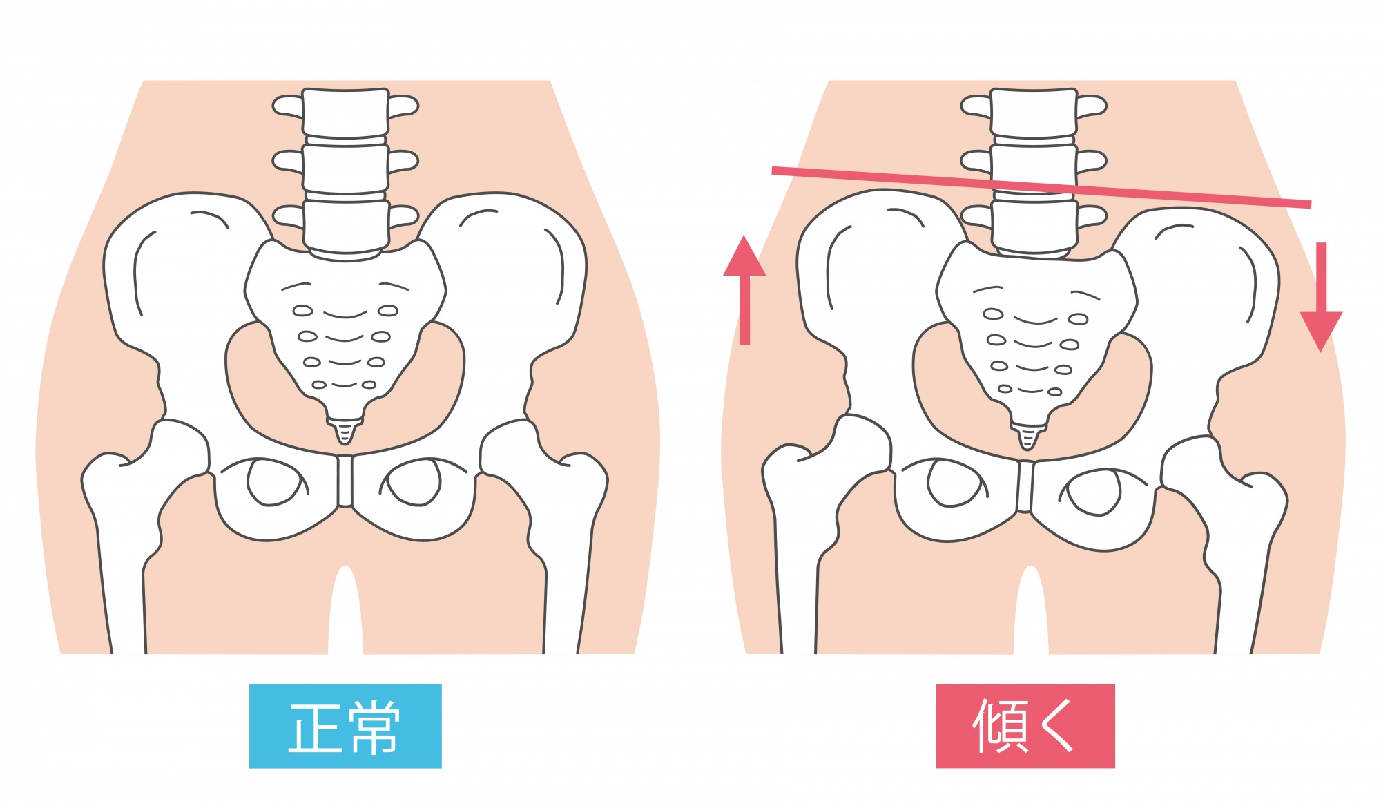 骨盤が左右に傾いたり歪んだりすることで、片方の足にばかり体重がかかるメカニズムのイラスト