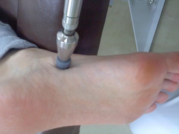 足底腱膜炎の施術の写真2.JPG