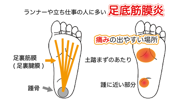 足底腱膜炎の痛みの出やすい部位.png