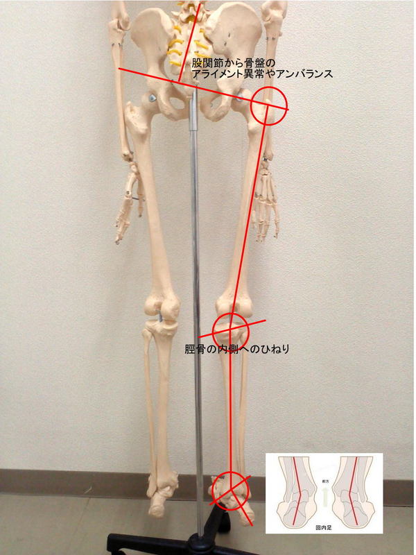 足首過回内の画像2.jpg