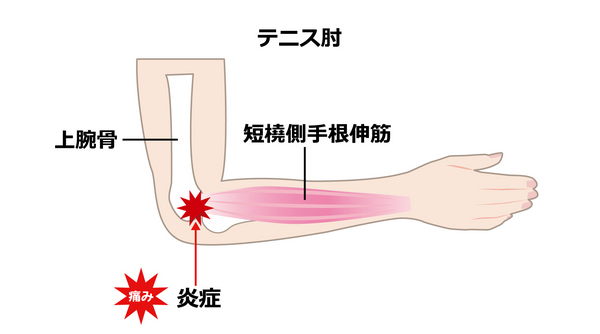 テニス肘の痛む場所1.jpg