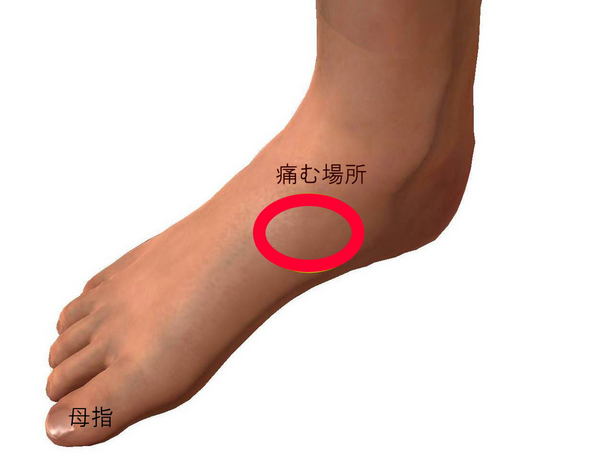 足の内側の痛み.jpg