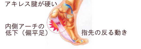 足底腱膜炎の原因の画像.jpg