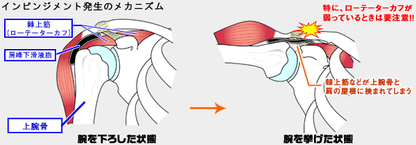 インピンジメント症候群.gif