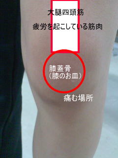 札幌市北区在住小学生S・S君の膝の痛む場所.jpg