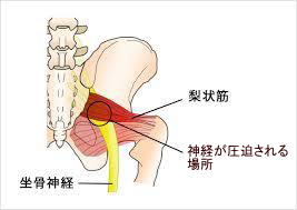 梨状筋症候群.jpg