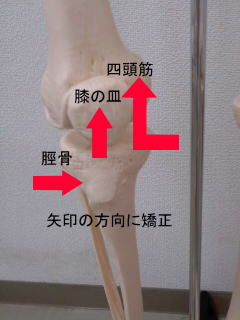 膝の矯正の写真2.jpg