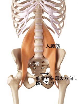 T・K君の仙骨のゆがみの方向.jpg