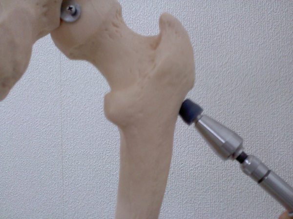 股関節の矯正の写真2