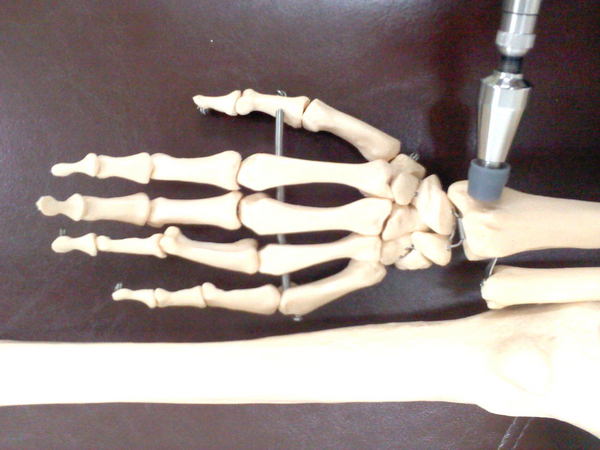手首の痛み・腱鞘炎の矯正3.jpg