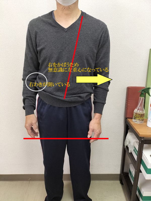 札幌市在住60代男性H・S様の右のギックリ腰の痛み.jpg