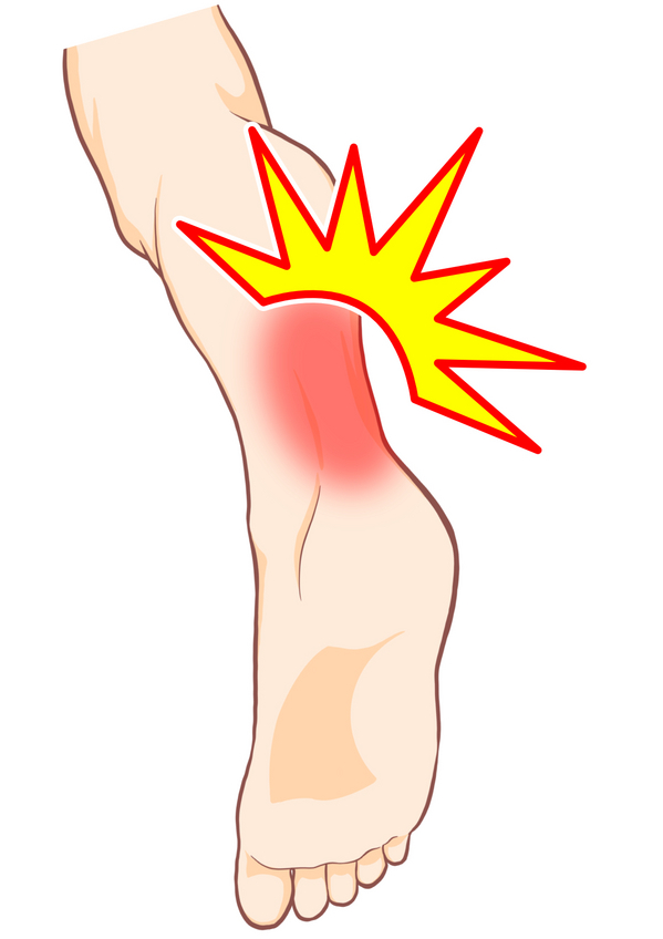 Achilles tendonitis.jpg