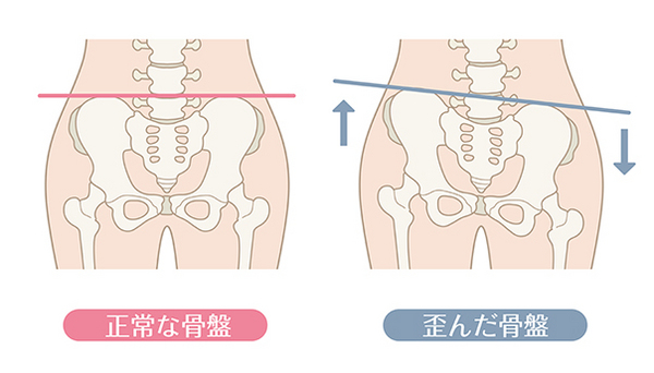 distortion of the pelvis.jpeg